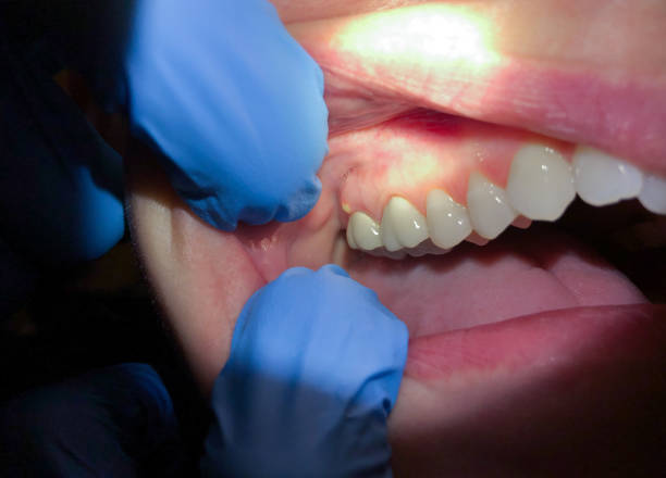 Best Broken or Cracked Tooth Emergency Dentist in New Smyrna Beach, FL